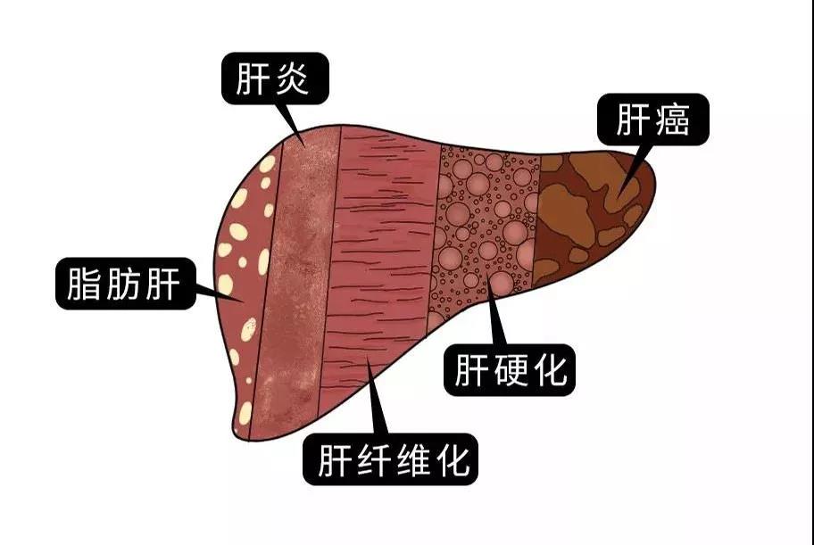 脂肪肝的最大敵人不是肥胖，答案竟是這樣！