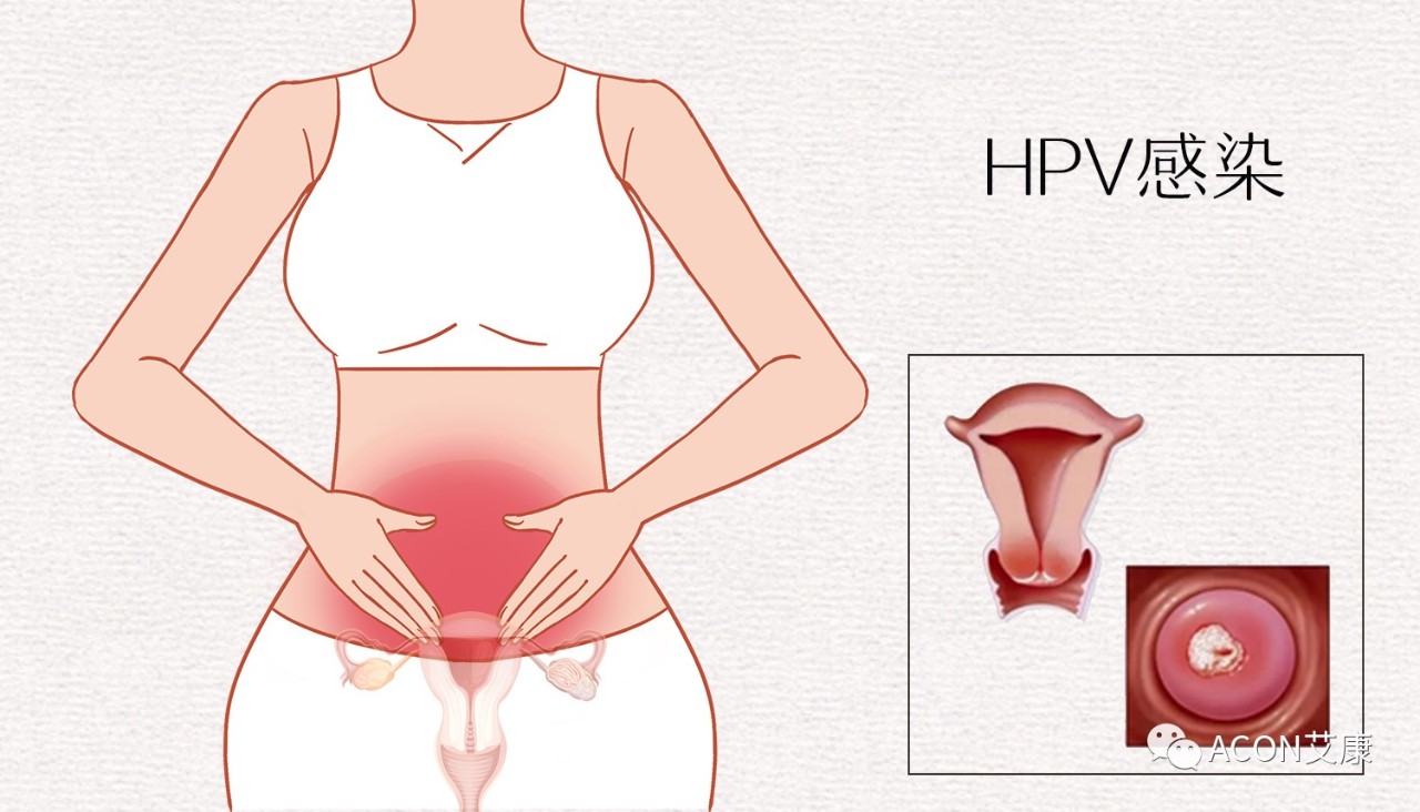 HPV轉(zhuǎn)陰其實(shí)很簡單， 女性必知的宮頸癌真相