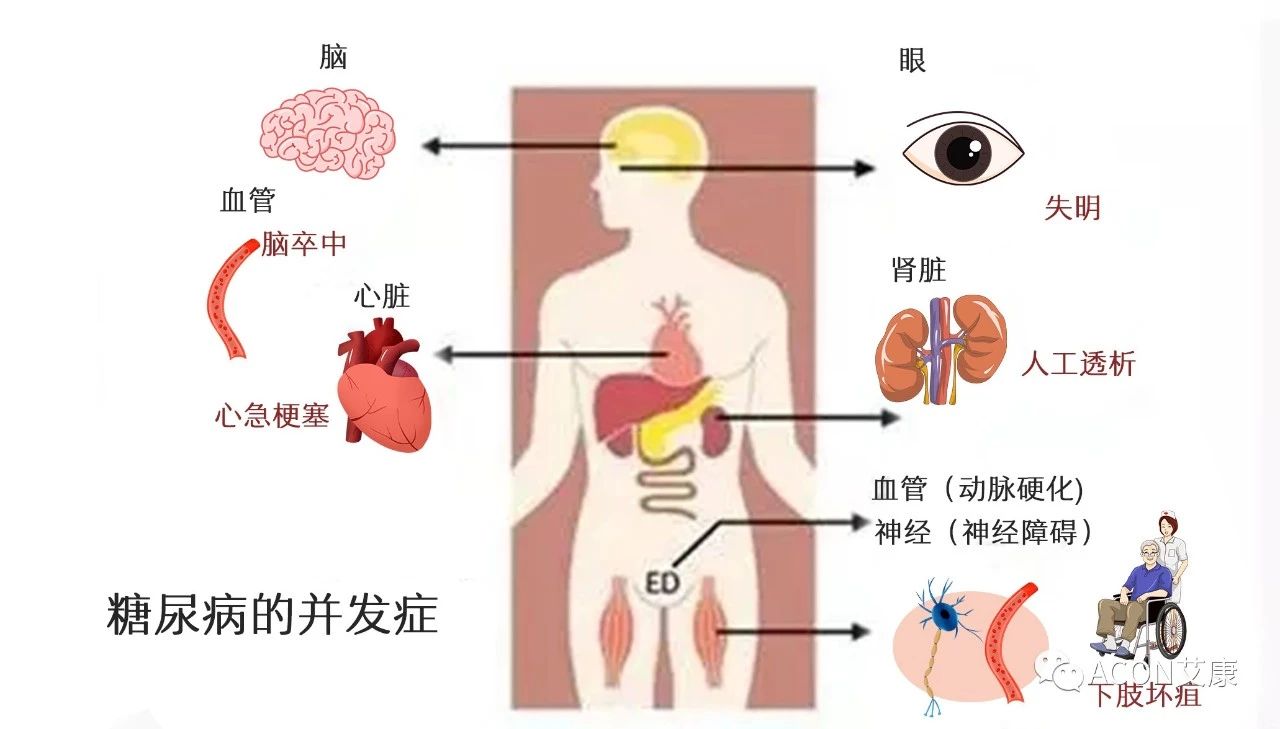 爆上熱搜，因爆發(fā)型糖尿病進(jìn)入ICU，有哪些教訓(xùn)值得我們汲取
