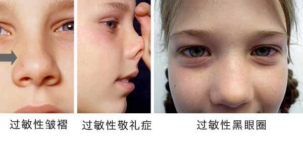 過敏性鼻炎會讓孩子變傻？！家長該如何應(yīng)對